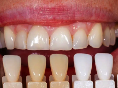 El 40% de la población se acompleja de su sonrisa por no poder blanquearse los dientes