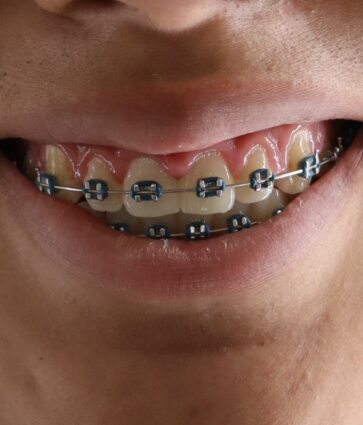 El 21% de la población tiene como objetivo alinear sus dientes en los próximos 12 meses