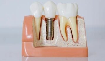 Dr. Javier Ortiz de Urbina: «El éxito de un implante dental depende en gran medida de la experiencia del profesional»