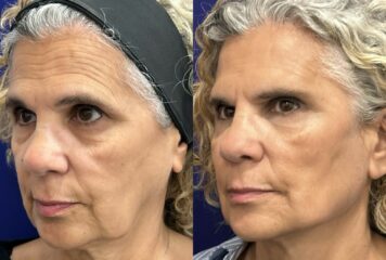 Global Face: nuevo protocolo integral del Dr. Ángel Martín para la recuperación de estructuras faciales, de la firmeza y elasticidad dérmica