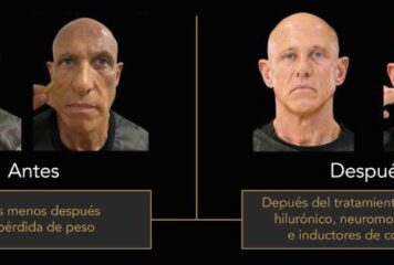 La otra cara del éxito de los GLP-1: el nuevo reto de la medicina estética